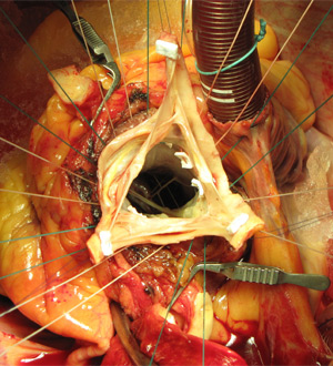 Chirurgie de la Valve Aortique