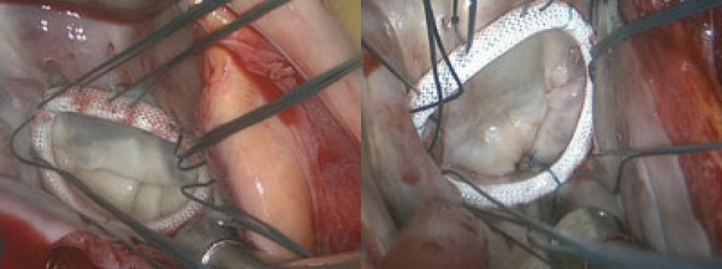 Réparation de la valve mitrale par méthode mini-invasive et robotique